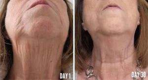 collagen-neck-30days