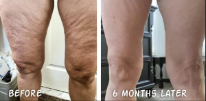 legs-6months-front